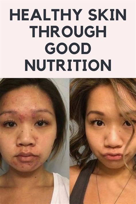 Healthy Skin Through Good Nutrition Healthy Skin Natural Skin Care