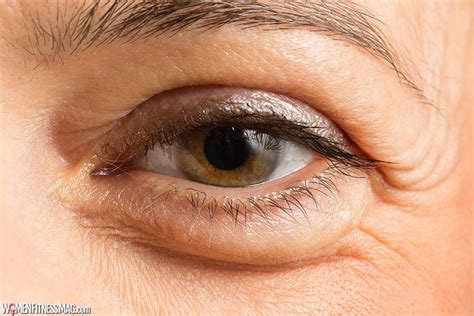 10 Reasons Why Your Eyelid Is Swollen Swollen Eyelid Swollen Eyes