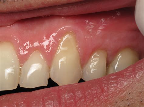 Thin Receding Gums And Dental Implants Whats Important Video By