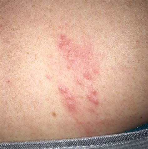 List Pictures Pictures Of Dermatitis On The Back Latest
