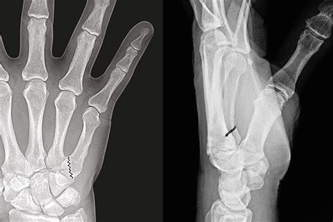 Little Metacarpal Fractures Hand Surgery Resource