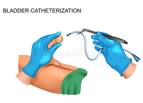 Catheterization Stock Illustrations 419 Catheterization Stock