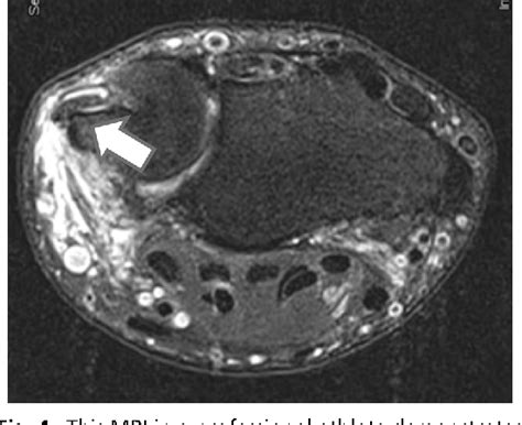 Figure 2 From Pathologies Of The Extensor Carpi Ulnaris Ecu Tendon