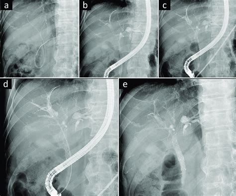A Case Of Bilateral Metal Stenting For Malignant Hilar Obstruction A