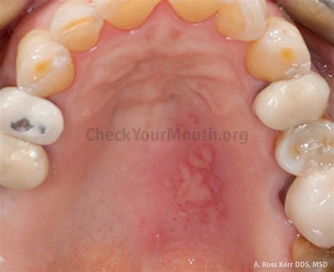 Healthy Roof Of Mouth