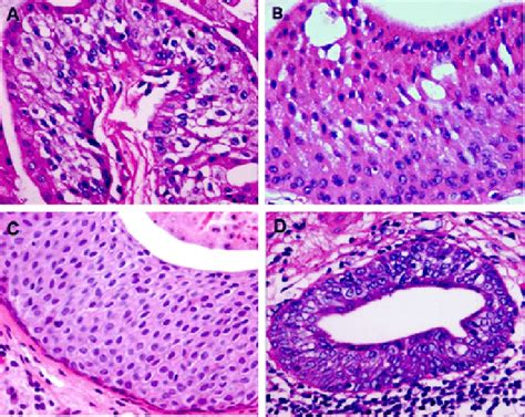 Microscopic Images Of Multilayered Squamoid Metaplasia Present In The