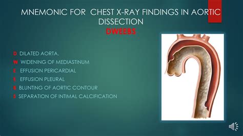 Aortic Dissection X Ray
