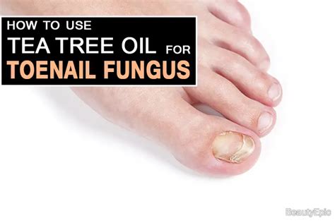 Tea Tree Oil To Treat Toenail Fungus And How To Use It