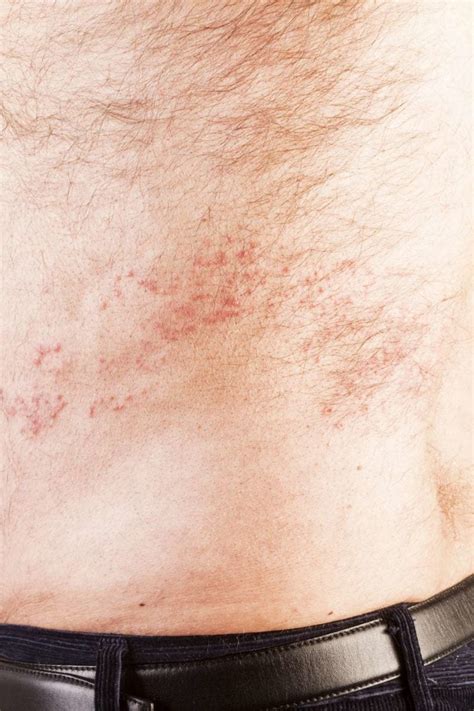 Shingles Skin Bumps Itchy Bumps Itchy Red Bumps Images And Photos Finder