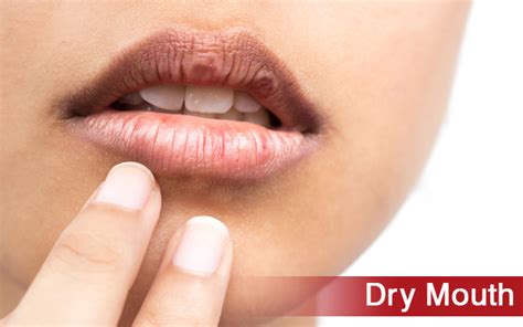 Dry Mouth Smile Signature Dental Clinic
