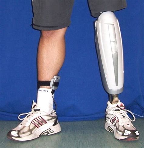 Power Knee Active Microprocessor Controlled Knee Prosthesis Ossur