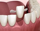 Maryland Dental Bridges | Dentist based in Kingston, London