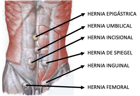 Cirurgia de Hérnia Instituto Morrell