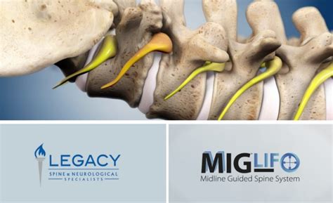 The Mig Lif Procedure Legacy Spine And Neurological Specialists