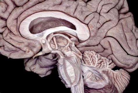 Medial Perspective Of Partially Dissected Brainstem Diencephalon And