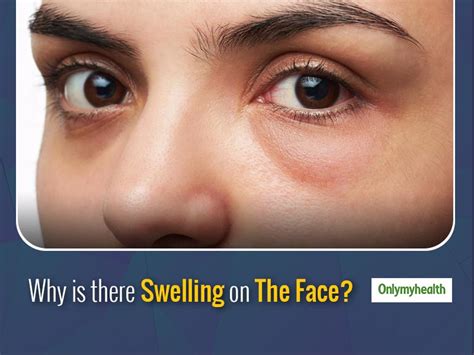 What Causes Swelling In The Face