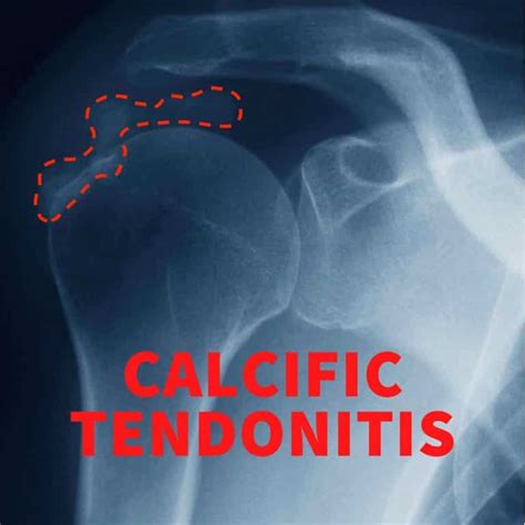 Calcific Tendonitis Causes Symptoms Treatment