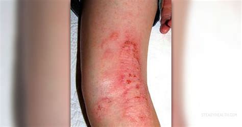 About Eczema Cure Skin And Hair Problems Articles Body And Health