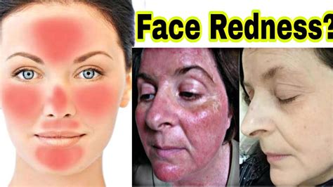 चेहरे पर Redness क्यों आती है Reasons Behind Face Redness Redness