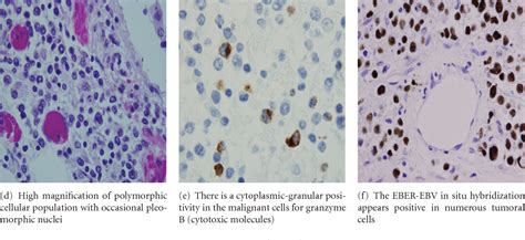 Figure 2 From Extranodal Nkt Cell Lymphoma Without Nasal Cavity