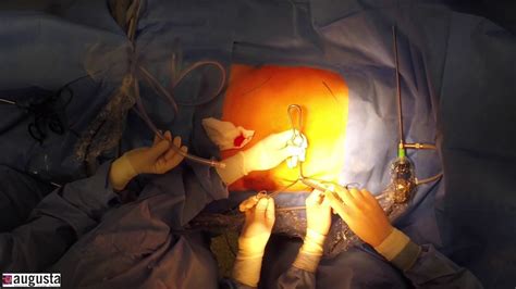 Laparoscopic Umbilical Hernia Repair With Mesh In Pump Technique Youtube