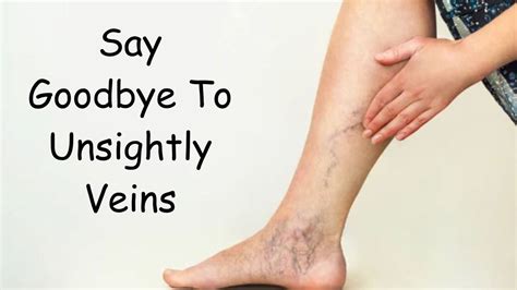 Say Goodbye To Unsightly Veins The Best Treatments Of 2023 Encino