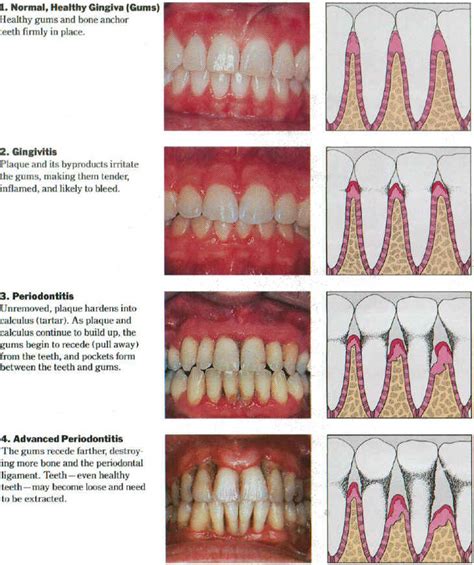 Do You Have Gum Disease What Are The Different Types The Smile Blog