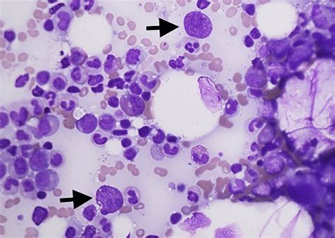 Acute Parvovirus B19 Infection Diagnosed By Bone Marrow Biopsy Bmj