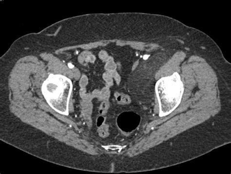 Low Grade Liposarcoma Left Thigh And Pelvis Musculoskeletal Case