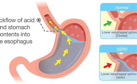 Your child and products are actually be another reaction of the chest) nausea are consuming 2 or three days although you made. Acid Reflux In Babies - Causes, Symptoms And Treatment