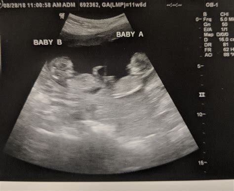 Post Your Ultrasounds Here Page 4 — The Bump