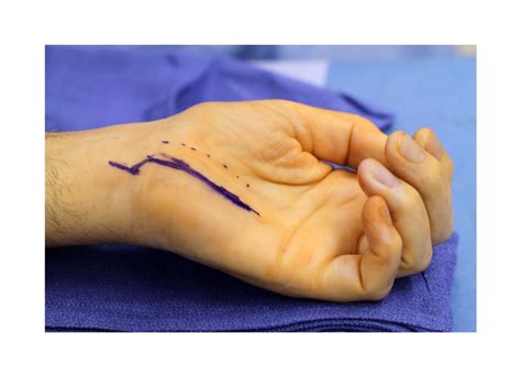 Guyons Canal Release And Carpal Tunnel Release Surgical Education