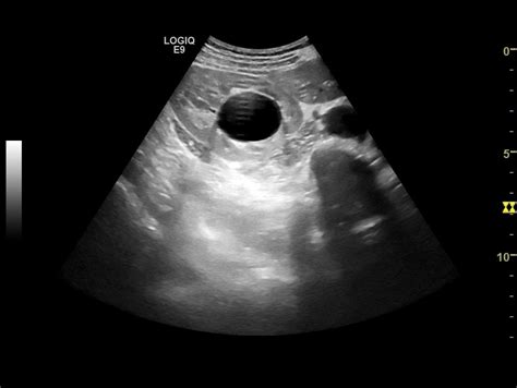 Renal Sinus Cyst Image