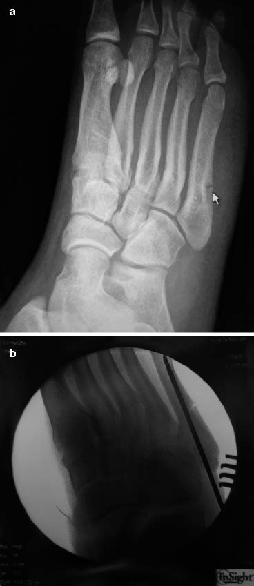 Stress Fractures Of The Foot And Ankle In Athletes Musculoskeletal Key