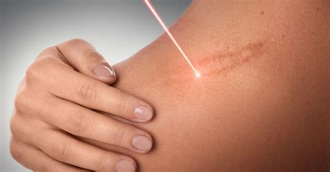 How Laser Treatments Can Help Fade Your Scars Cnet