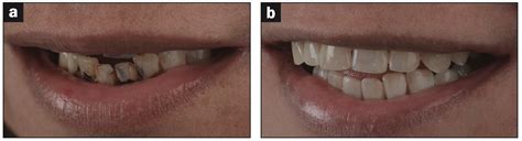 Use Of Minimally Invasive Techniques And Antimicrobial Agents To Treat