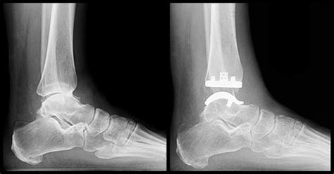 Ankle Joint Replacement Bunbury Foot And Ankle Surgeon