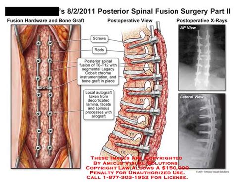 AMICUS Illustration Of Amicus Surgery Throacic Spine Spinal Fusion Part
