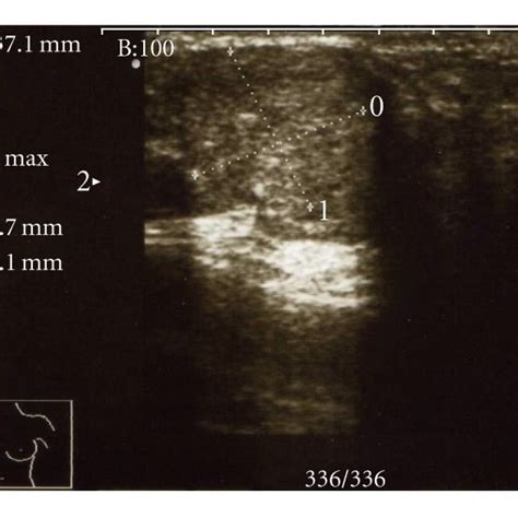 Mammary Ductoscopy Image Showing Intraductal Papilloma Download