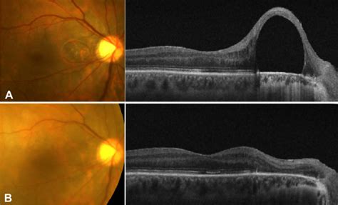 A Preoperative Fundus Photograph Left And Optical Coherence