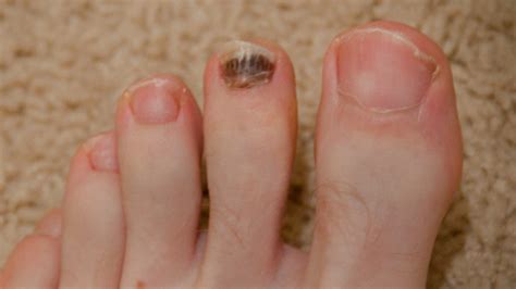White Patches On Toenails Causes Signs Best Treatment Vrogue Co