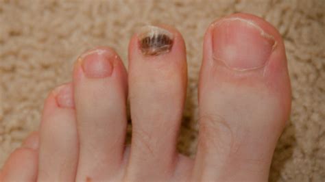 Discoloured Toenails From Nail Polish Nail Ftempo