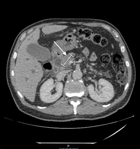 Contrast Induced Rhabdomyolysis Occurring After Ercp In A Patient With