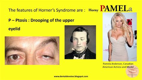 Mnemonics Horner S Syndrome Youtube