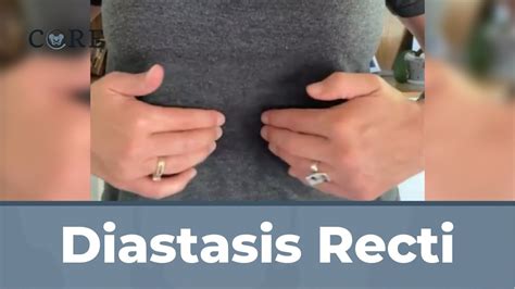 Diastasis Recti Youtube