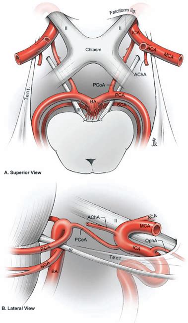 Posterior Communicating Artery Aneurysms Neupsy Key
