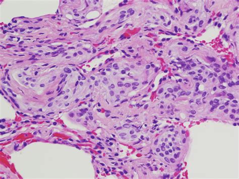 Meningothelial Like Nodules In Transbronchial Lung Biopsy Specimen