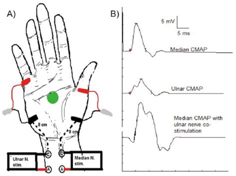 Clinical And Electrophysiological Evaluation Of Carpal Tunnel Syndrome