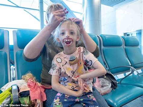 Russian Girl Born Without Half Her Face Can Smile For The First Time