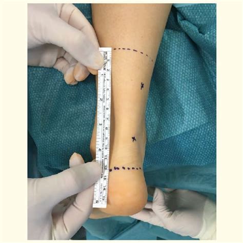 Endoscopic Debridement Of The Achilles Paratenon With The Palpator